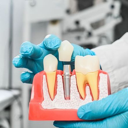 Gloved hands holding a jaw model with two natural teeth and a dental implant, lifting a crown above the implant